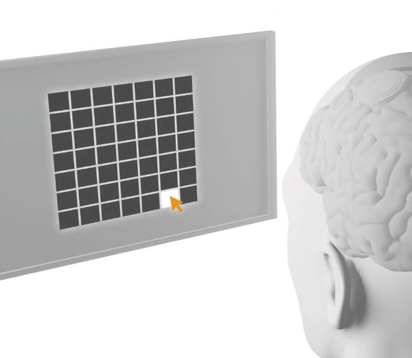 뉴럴링크의 BCI 기술 임상시험 이미지. (사진=뉴럴링크)