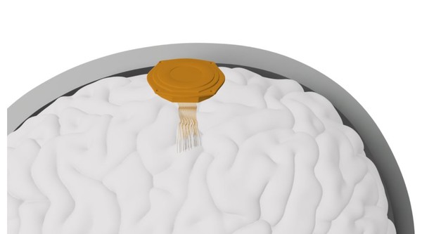 뉴럴링크는 뇌의 운동피질에 동전 크기의 구멍을 뚫고 원격제어 무선 칩을 이식하는 방식을 적용하고 있다. (사진=뉴럴링크)